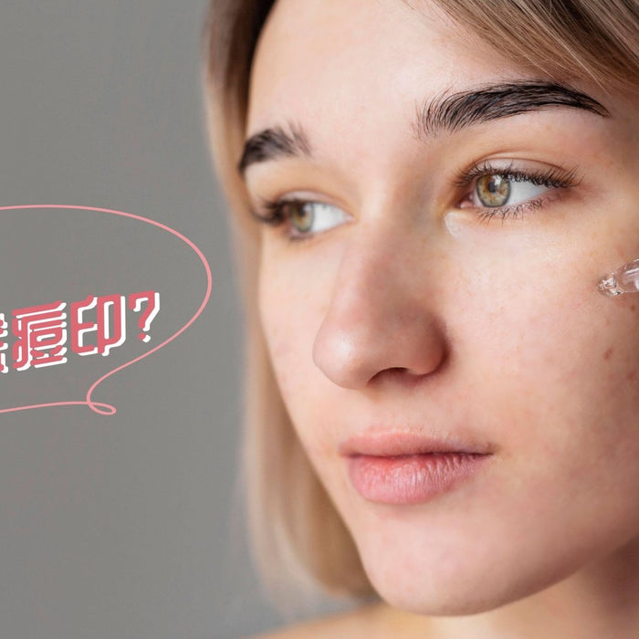 還原白滑肌膚-3招快速告別難纏痘印 Pretties.com.hk