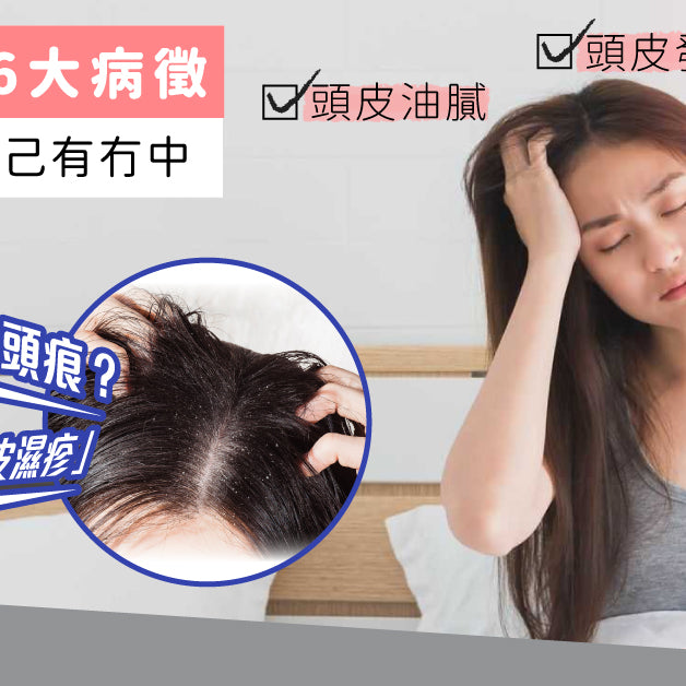 【Flaking and itchy？】It might be Scalp Eczema! 6 symptoms to check on!