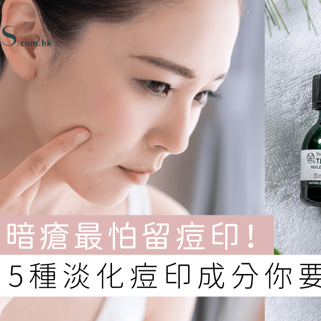 生暗瘡最怕留痘印-5種淡化痘印成分你要識 Pretties.com.hk